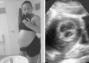 Histoire de naissance : "Vous n'allez pas le croire... il y a trois battements de cœur"